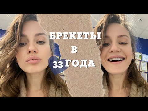 Видео: брекеты после 30 лет || нужно ли ставить брекеты