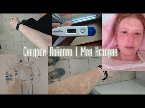 Видео: Синдром Лайелла | Моя история | Начало