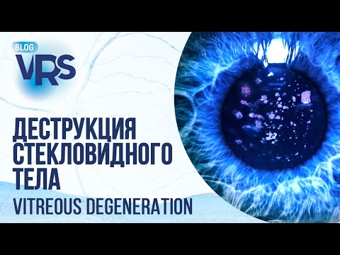 Видео: Деструкция стекловидного тела: нужно ли оперировать? | Vitreous degeneration: to operate or not?