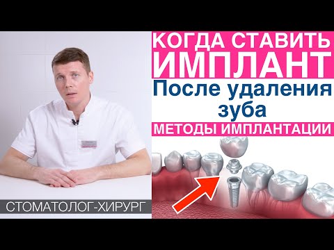 Видео: Когда устанавливать зубной имплант после удаления зуба? Методики имплантации зубов.