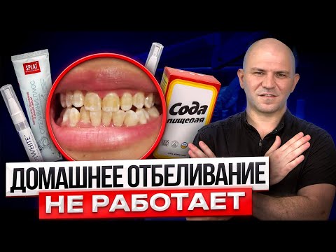 Видео: Вся Правда Про Отбеливание Зубов В Домашних Условиях. Последствия отбеливания зубов.