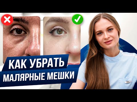 Видео: Можно ли убрать малярные мешки и суфы ?
