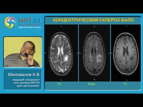 Видео: «Дифференциальная диагностика очаговых и объемных изменений головного мозга»
