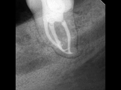 Видео: Лечение восьмерки системой S flexy