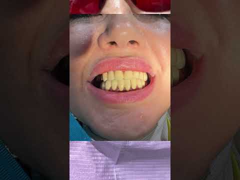 Видео: Тиш солиш