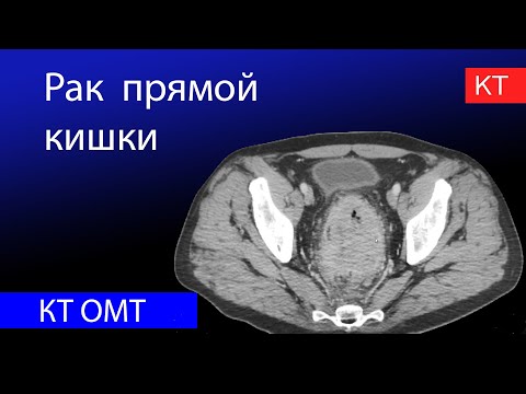 Видео: Рак прямой кишки на КТ