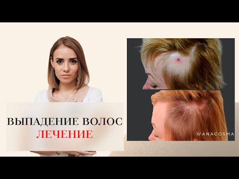 Видео: ВЫПАДЕНИЕ ВОЛОС. АЛОПЕЦИЯ. КАК ОСТАНОВИТЬ ВЫПАДЕНИЕ ВОЛОС⁉️ 😱