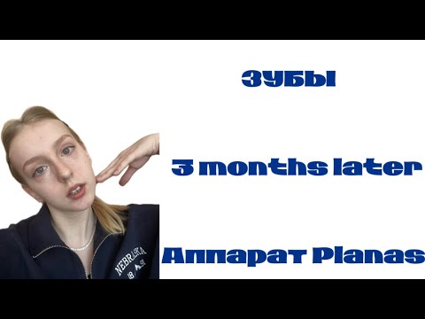 Видео: без брекетов: как проходит мое лечение на аппарате Planas через почти 3 месяца