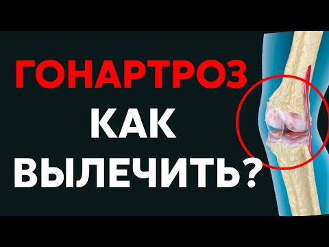 Видео: Гонартроз, артроз коленного сустава | Доктор Черкасов