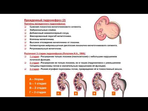 Видео: УЗИ. Доктор Иогансен. Выпуск 74. Аномалии развития почек и мочеточников. Часть 6.