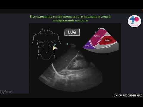 Видео: eFAST протокол для врача АиР