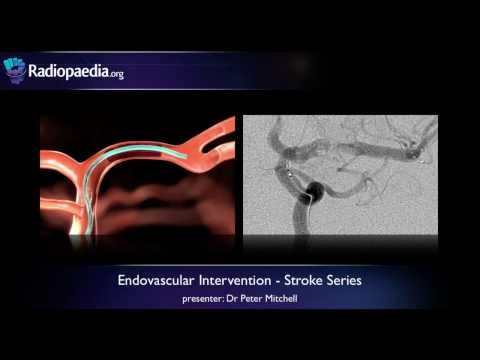 Видео: Инсульт: Эндоваскулярное лечение ишемического инсульта — видеоурок по радиологии