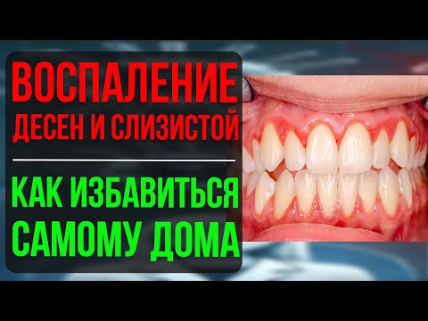 Видео: Воспаление во рту. Как быстро снять воспаление десен и слизистой оболочки дома?