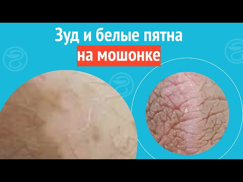 Видео: 😧 Зуд и белые пятна на мошонке. Клинический случай №1675