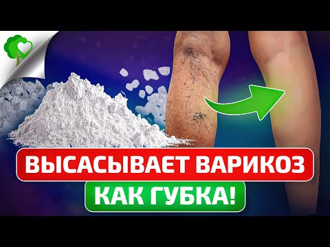 Видео: Оказывается, варикоз реально лечится — просто и дома!