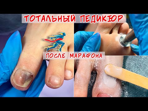 Видео: Полный педикюр / Онихолизис ногтей и синяк под ногтем