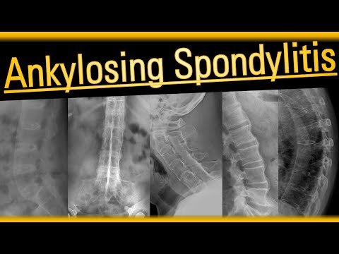 Видео: Анкилозирующий спондилит #артрит #рентгенология #кости