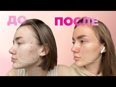 Видео: ГОД БЕЗ САХАРА | КАК ОТКАЗАТЬСЯ ОТ СЛАДКОГО И ВЫЛЕЧИТЬ КОЖУ