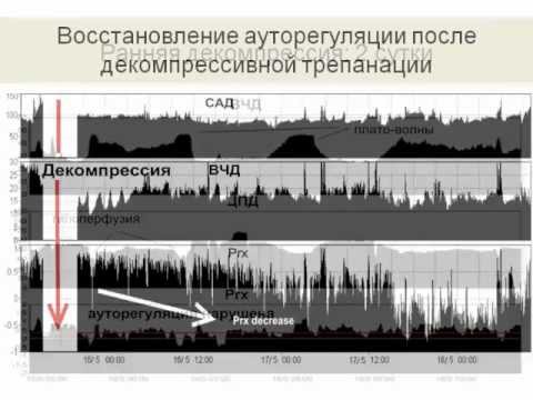 Видео: 1МСН ЦПД в Нейрореанимации. (перфузия головного мозга)