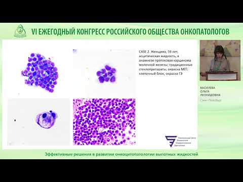 Видео: Эффективные решения в развитии онкоцитопатологии выпотных жидкостей