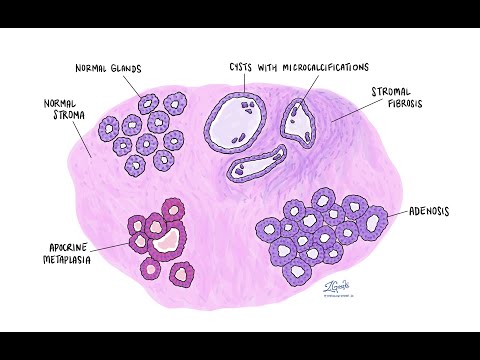 Видео: 48. Солитарная фиброзная опухоль молочной железы (гемангиоперицитома)