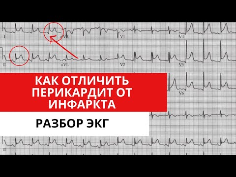 Видео: Перикардит или инфаркт? ЭКГ диагностика.