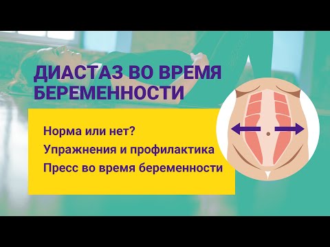 Видео: Диастаз у беременных в 3 триместре беременности. Профилактика и упражнения для беременных