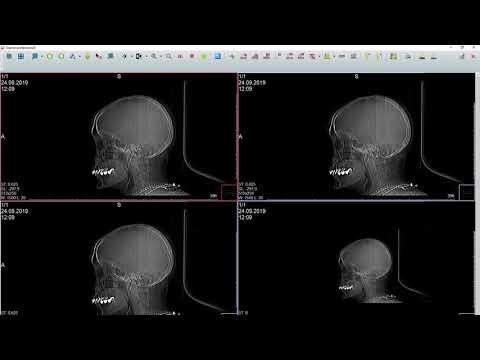 Видео: Как посмотреть запись исследования МРТ или КТ на диске