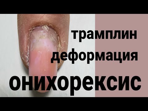 Видео: САМЫЕ СЛОЖНЫЕ  руки / коррекция трамплинов / деформация всех ногтей / онихорексис  расщепление нп