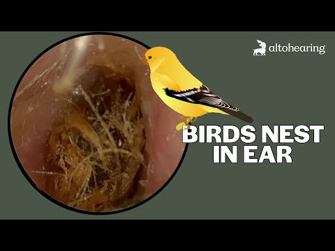 Видео: Скрытое «птичье гнездо» из ушной серы — аккуратно удалено