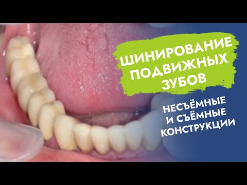 Видео: Шинирование подвижных зубов. Несъёмные и съёмные конструкции.