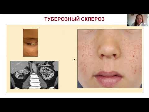 Видео: ГЕМОФИЛЬНАЯ ИНФЕКЦИЯ У ДЕТЕЙ