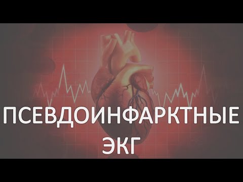 Видео: Псевдоинфарктные ЭКГ: Имитация элевации ST; Псевдокоронарный Т; "Фейковая" гиперкалиемия. Часть #2