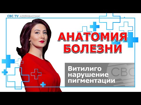 Видео: Витилиго - нарушение пигментации. Причины и виды витилиго. Диагностика и лечение витилиго