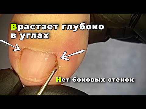 Видео: Порыться в кожных слоях. Колет где-то глубоко в углах.