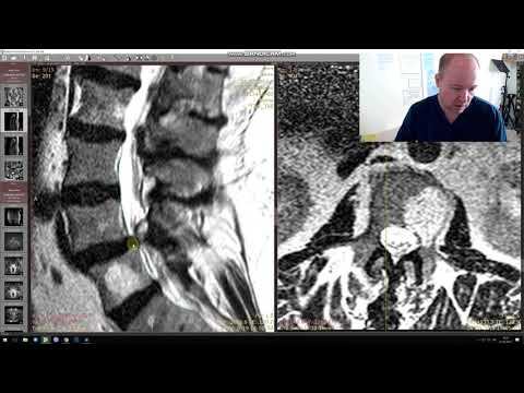 Видео: Фасеточный синдром. Боль в пояснице. Блокады не помогли
