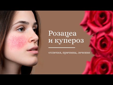 Видео: Розацеа и купероз. В чём отличия и как избавиться?