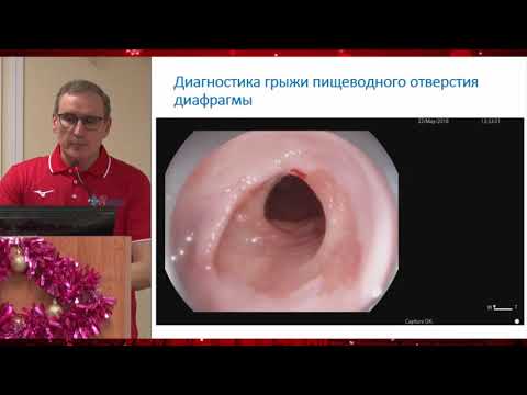 Видео: Актуальность стандартов диагностики пищевода Баррета. С. В. Кашин