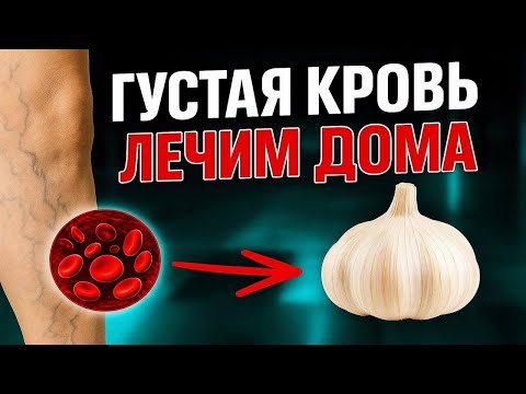 Видео: 5 ДОМАШНИХ СОВЕТОВ по разжижению крови в домашних условиях от врача-флеболога!