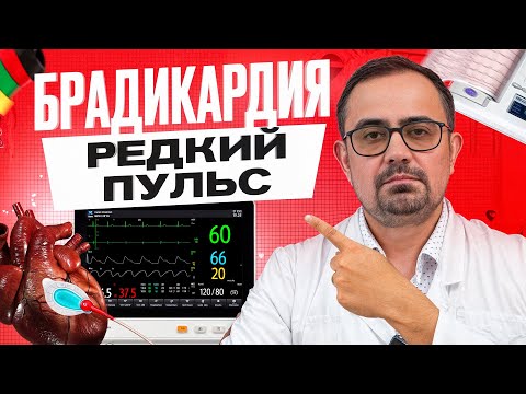 Видео: Пульс меньше 60 – норма или паталогия? Причины и лечение редкого пульса (брадикардия)