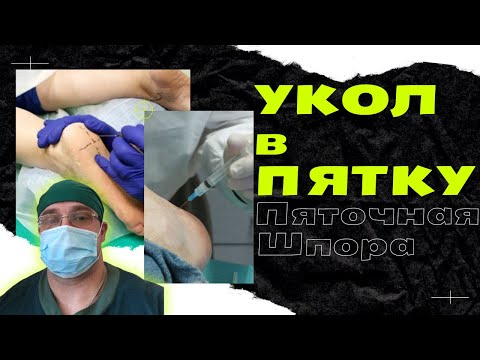 Видео: БОЛЬ в ПЯТКЕ | Плантарный Фасциит | Пяточная Шпора | Симптомы и Лечение