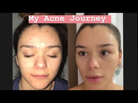 Видео: МОЙ ПУТЬ С АККУТАНОМ (как я избавилась от прыщей)