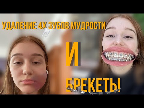 Видео: удалили ВСЕ ЗУБЫ мудрости | поставили брекеты | моя история