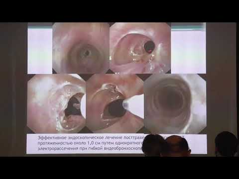 Видео: 14 Герасин АВ Выбор тактики лечения рубцовых стенозов трахеи