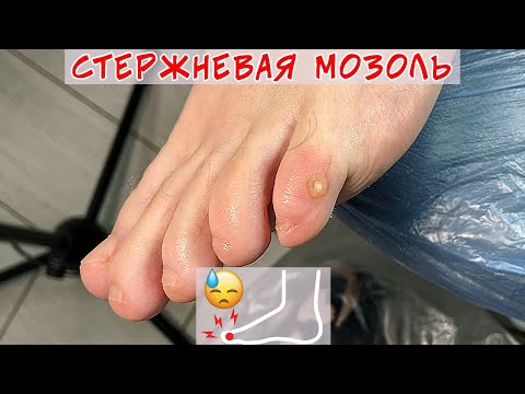 Видео: Удаление стрежневой мозоли на мизинце