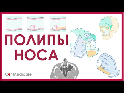 Видео: Полипы носа - что такое, причины, методы лечения - кратко