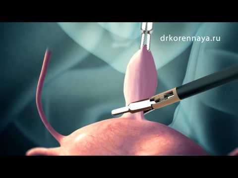 Видео: Миома матки. Хирургическое лечение.
