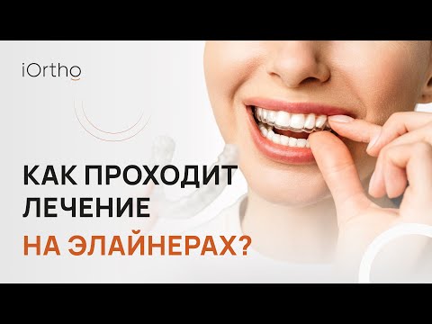 Видео: 👉 Как проходит лечение на элайнерах
