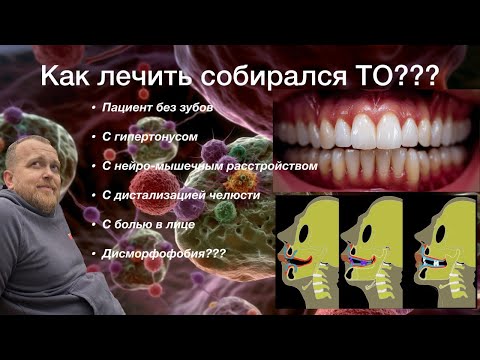 Видео: Депрограммация и создание межальвеолярной высоты при полной потере зубов