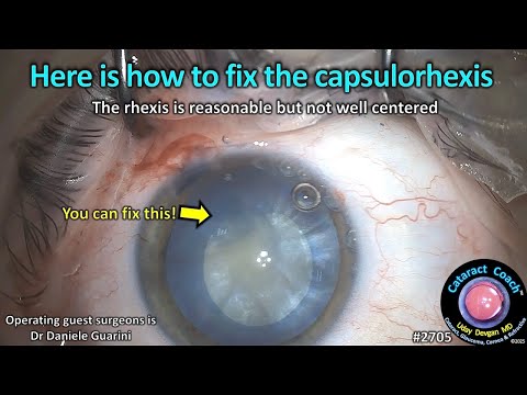 Видео: CataractCoach™ 2705: как исправить капсулорексис